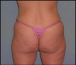 Belt Lipectomy