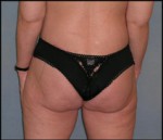 Belt Lipectomy