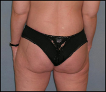 Before After Photos Belt Lipectomy