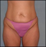 Belt Lipectomy