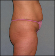 Belt Lipectomy Case 94 Before Photo Belt Lipectomy