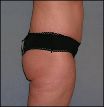 Belt Lipectomy Case 94 After Photo Belt Lipectomy