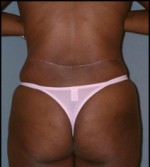 Belt Lipectomy