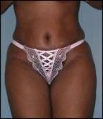 Belt Lipectomy