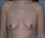 Augmentation Mammoplasty
