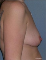 Augmentation Mammoplasty