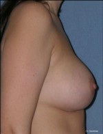 Augmentation Mammoplasty