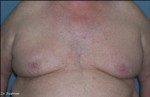 Male Breast Reduction
