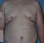 Male Breast Reduction