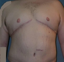 Male Breast Reduction Before and After Photos | Dr. Balakhani