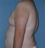 Male Breast Reduction