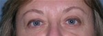 Blepharoplasty