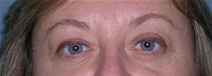 Blepharoplasty Case 13 Before Photo Blepharoplasty