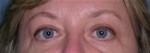 Blepharoplasty