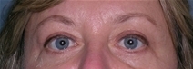 Blepharoplasty Case 13 After Photo Blepharoplasty