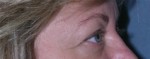 Blepharoplasty