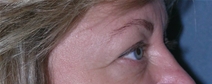 Blepharoplasty Case 13 Before Photo Blepharoplasty