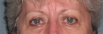 Blepharoplasty Case 24 Before Photo Blepharoplasty