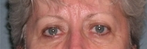 Blepharoplasty Before and After Photos