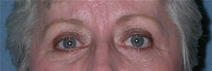 Blepharoplasty Before and After Photos