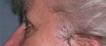 Blepharoplasty