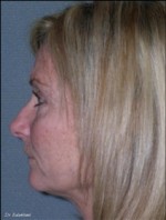 Facelift