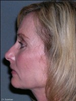 Facelift