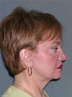 Facelift