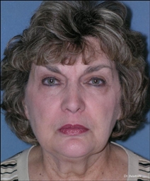 Facelift Before and After Photos