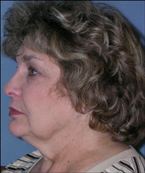 Facelift Before and After Photos