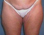 Body Liposculpture