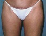 Body Liposculpture