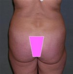 Body Liposculpture