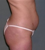 Body Liposculpture