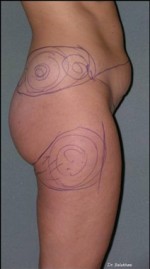 Tummy Tuck