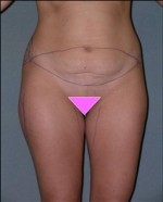 Tummy Tuck