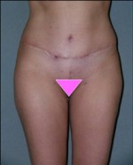 Tummy Tuck