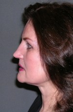 Facelift