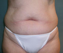 Tummy Tuck Before and After Photos