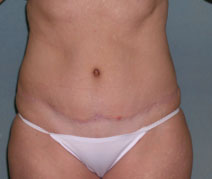 Tummy Tuck Before and After Photos