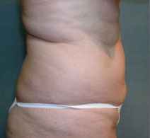 Tummy Tuck Before and After PhotosTummy Tuck Before and After Photos