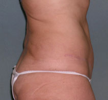 Tummy Tuck Before and After Photos