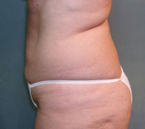 Tummy Tuck Before and After Photos