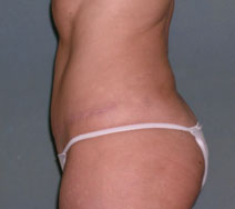 Tummy Tuck Before and After Photos