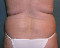 Tummy Tuck Before and After Photos