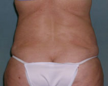 Tummy Tuck Before and After Photos