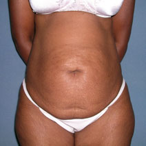 Tummy Tuck Before and After Photos