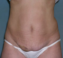 Tummy Tuck Before and After Photos