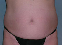 Tummy Tuck Before and After Photos