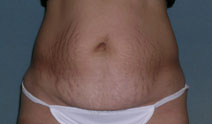 Tummy Tuck Before and After Photos